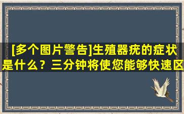 [多个图片警告]生殖器疣的症状是什么？三分钟将使您能够快速区分！